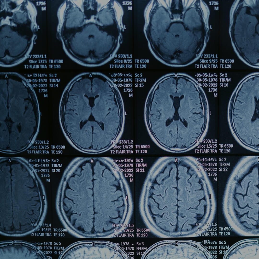 Assault-Related Brain Injury Lawsuits